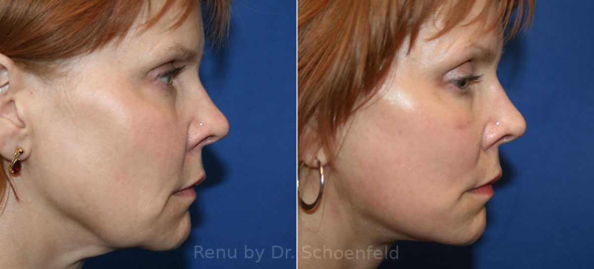 Facelift Before and After Photos in DC, Patient 12394