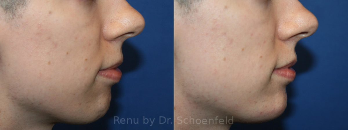 Dermal Filler Before and After Photos in DC, Patient 12441