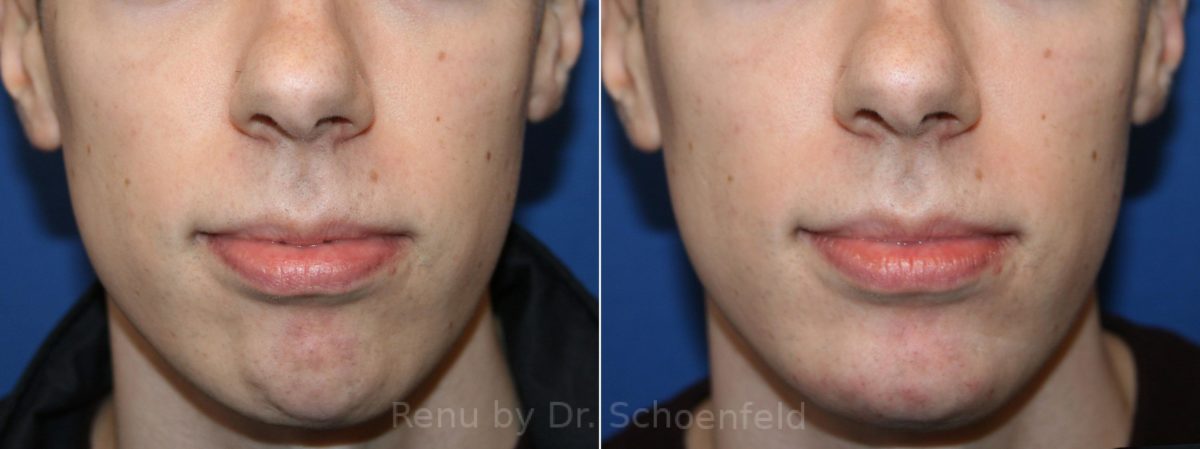 Dermal Filler Before and After Photos in DC, Patient 12441