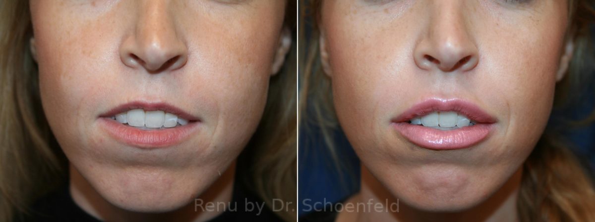 Dermal Filler Before and After Photos in DC, Patient 12451