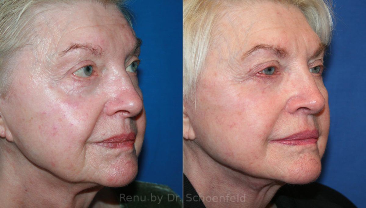 Facelift Before and After Photos in DC, Patient 12431