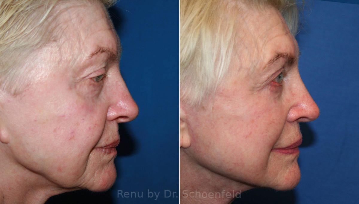 Facelift Before and After Photos in DC, Patient 12431
