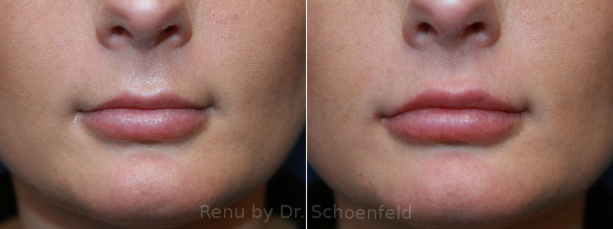 Dermal Filler Before and After Photos in DC, Patient 12471