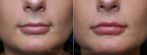 Dermal Filler Before and After Photos in DC, Patient 12471