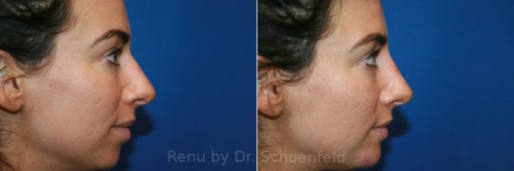 Dermal Filler Before and After Photos in DC, Patient 12568