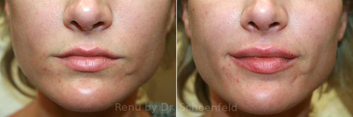 Dermal Filler Before and After Photos in DC, Patient 12600