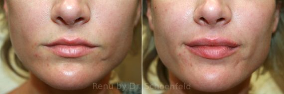 Dermal Filler Before and After Photos in DC, Patient 12600