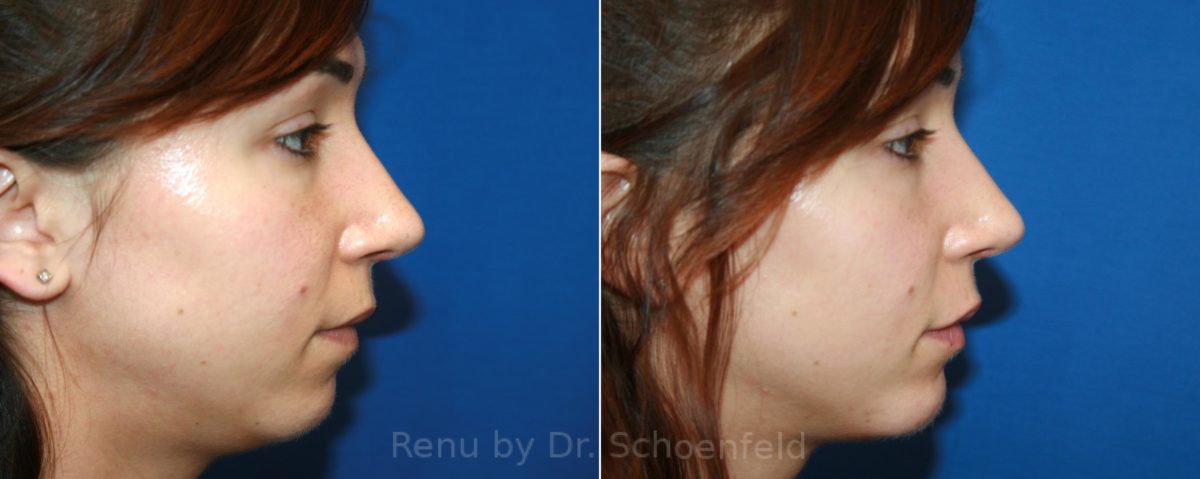 Chin Implant Before and After Photos in DC, Patient 12608