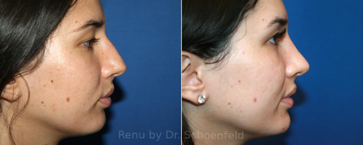 Rhinoplasty Before and After Photos in DC, Patient 12612