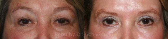 Blepharoplasty Before and After Photos in DC, Patient 12662
