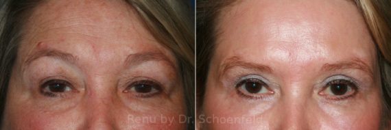 Brow Lift Before and After Photos in Chevy Chase, MD