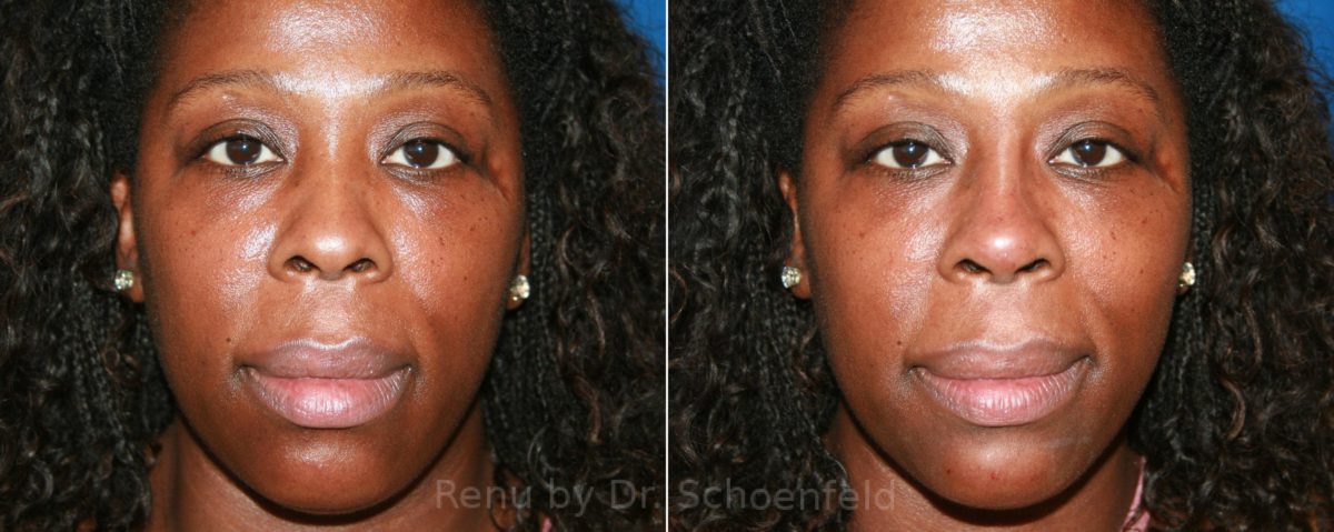 Dermal Filler Before and After Photos in DC, Patient 12825