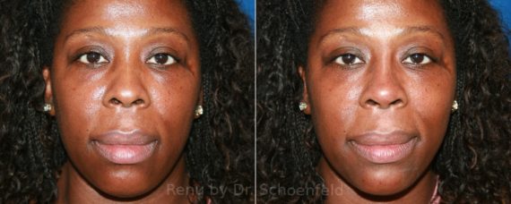 Dermal Filler Before and After Photos in DC, Patient 12825