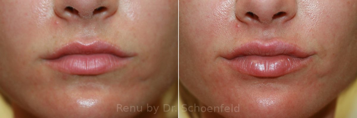 Dermal Filler Before and After Photos in DC, Patient 12811