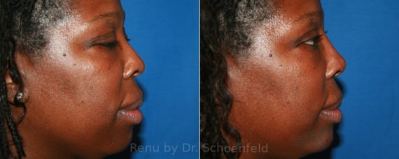 Dermal Filler Before and After Photos in DC, Patient 12825
