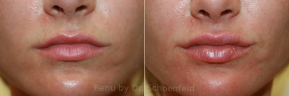 Dermal Filler Before and After Photos in DC, Patient 12811