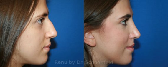 Rhinoplasty Before and After Photos in DC, Patient 12796