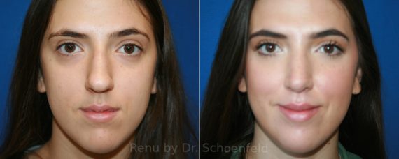 Rhinoplasty Before and After Photos in DC, Patient 12796