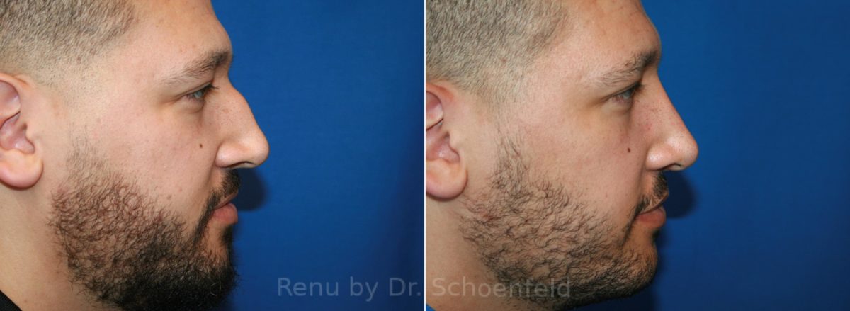 Rhinoplasty Before and After Photos in DC, Patient 12836