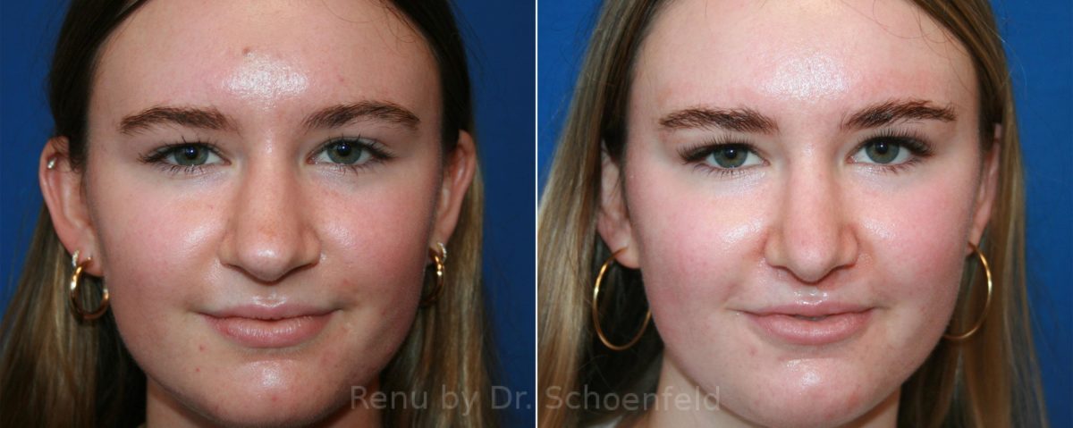 Rhinoplasty Before and After Photos in DC, Patient 12887