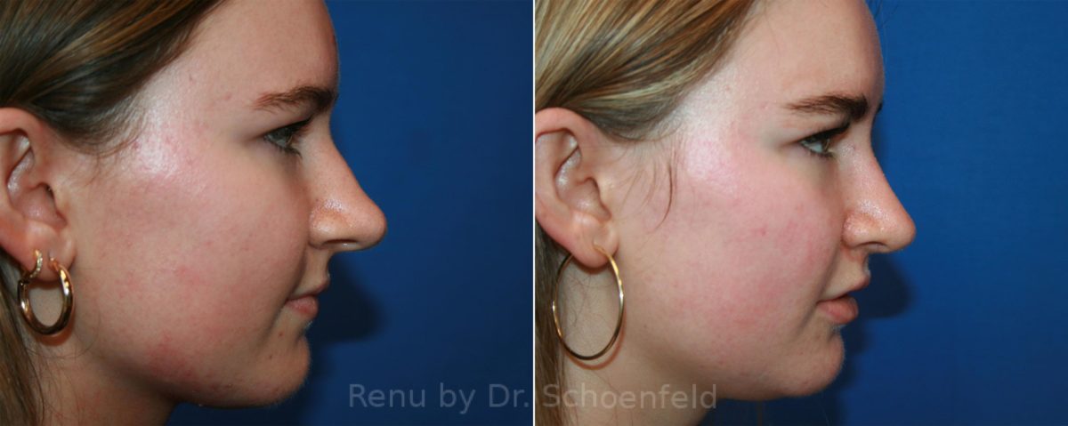 Rhinoplasty Before and After Photos in DC, Patient 12887