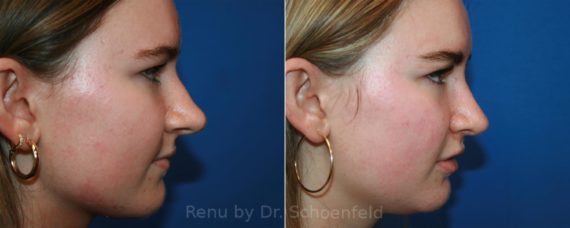 Rhinoplasty Before and After Photos in DC, Patient 12887