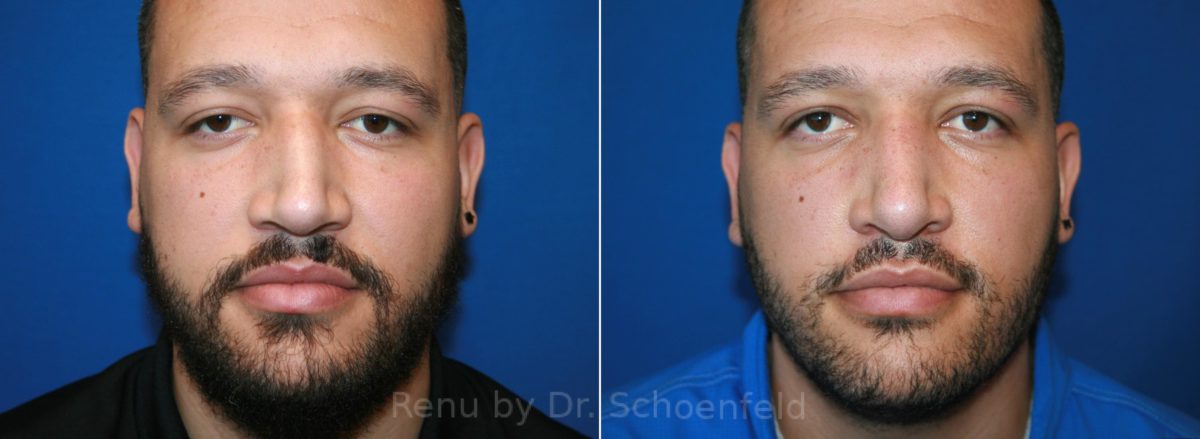 Rhinoplasty Before and After Photos in DC, Patient 12836