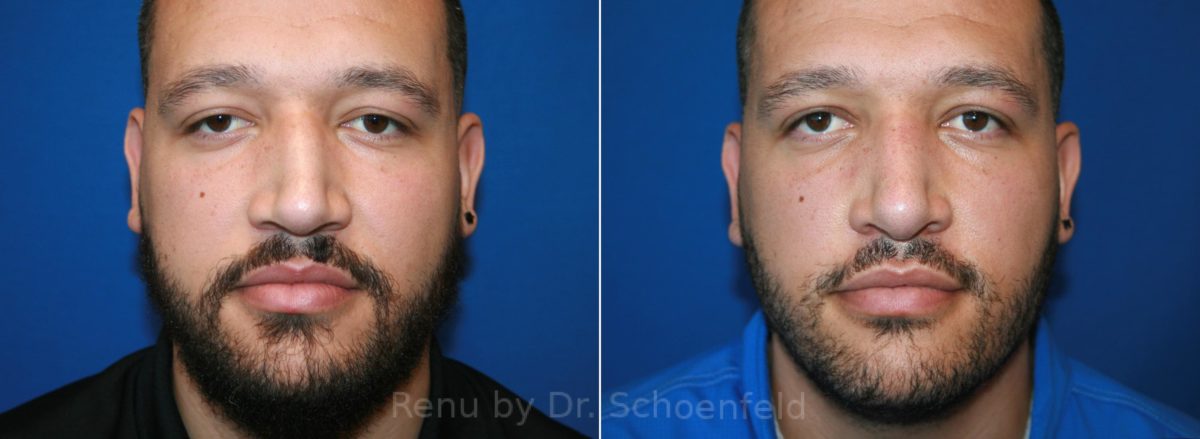 Patient 12836, Rhinoplasty Before and After Photos Rhinoplasty Before and After Photos in DC, Patient 12836