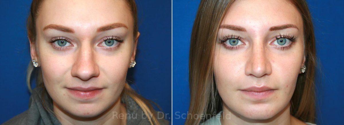Patient 12847, Rhinoplasty Before and After Photos Rhinoplasty Before and After Photos in DC, Patient 12847