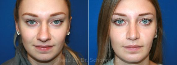 Rhinoplasty Before and After Photos in DC, Patient 12847