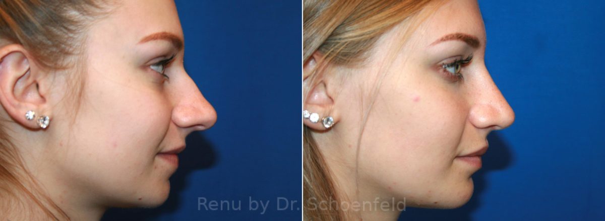 Patient 12847, Rhinoplasty Before and After Photos Rhinoplasty Before and After Photos in DC, Patient 12847