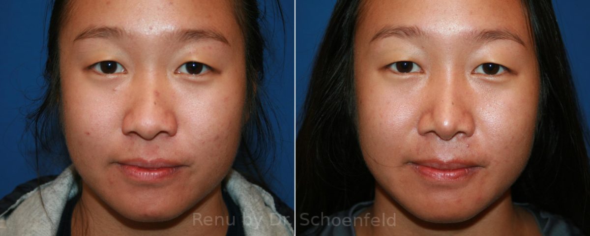 Rhinoplasty Before and After Photos in DC, Patient 12855
