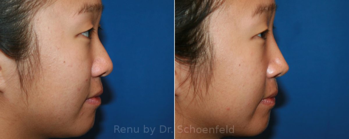 Rhinoplasty Before and After Photos in DC, Patient 12855