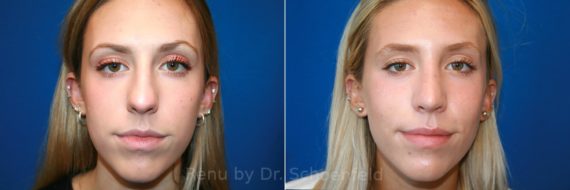 Rhinoplasty Before and After Photos in DC, Patient 12863