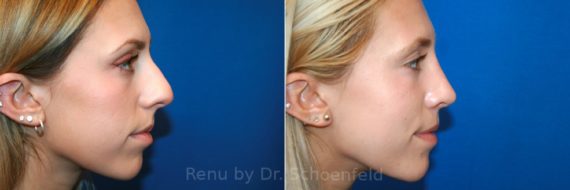 Rhinoplasty Before and After Photos in DC, Patient 12863