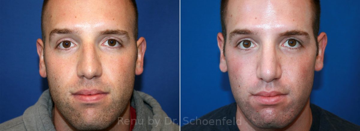 Rhinoplasty Before and After Photos in DC, Patient 12875