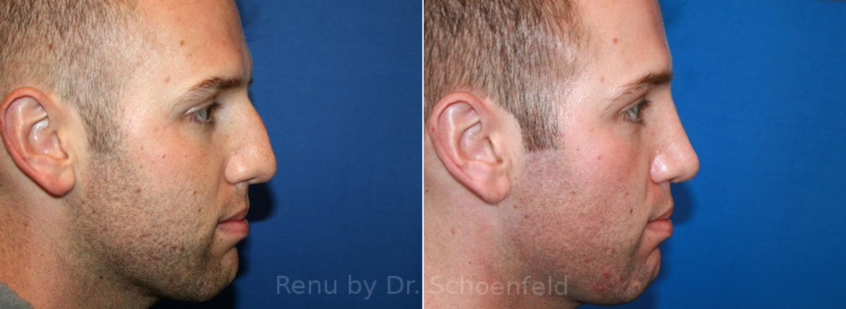 Rhinoplasty Before and After Photos in DC, Patient 12875