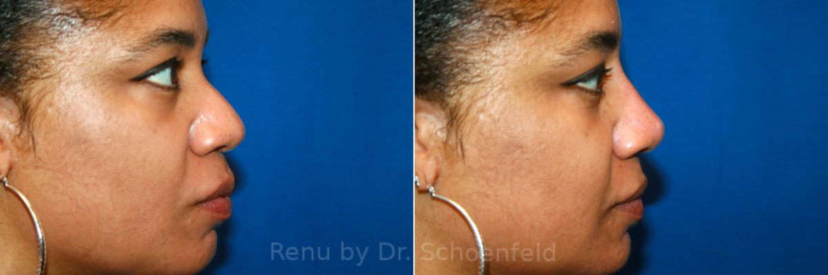 Non-Surgical Rhinoplasty Before and After Photos in DC, Patient 12900