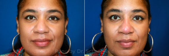 Non-Surgical Rhinoplasty Before and After Photos in DC, Patient 12900