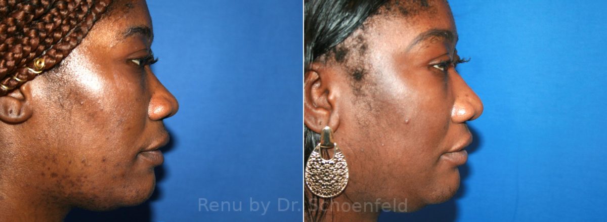 Rhinoplasty Before and After Photos in DC, Patient 12908