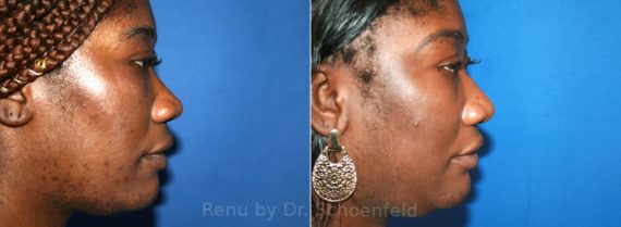 Rhinoplasty Before and After Photos in DC, Patient 12908