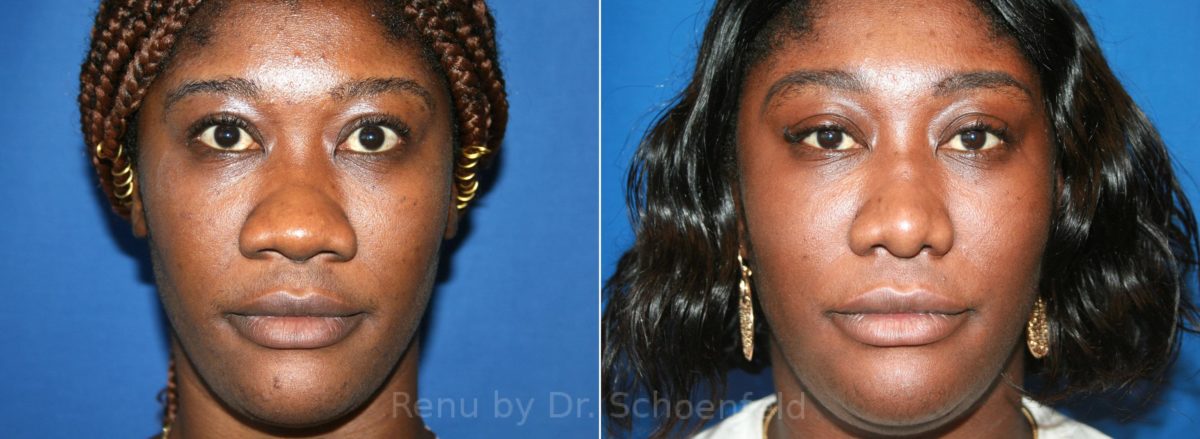 Patient 12908, Rhinoplasty Before and After Photos Rhinoplasty Before and After Photos in DC, Patient 12908