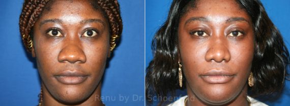 Rhinoplasty Before and After Photos in DC, Patient 12908