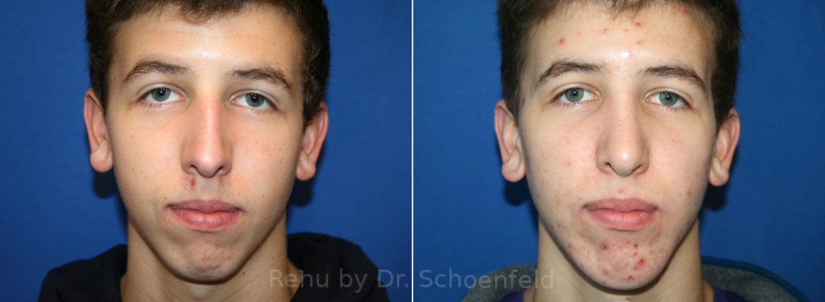 Chin Implant Before and After Photos in DC, Patient 12937
