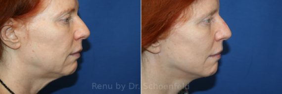 Facelift Before and After Photos in DC, Patient 12970
