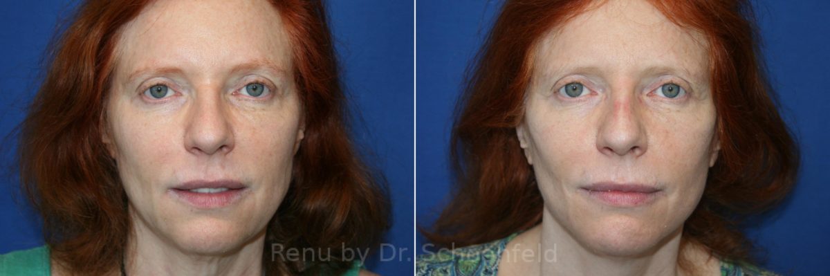 Facelift Before and After Photos in DC, Patient 12970