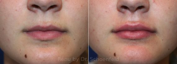 Dermal Filler Before and After Photos in DC, Patient 12991