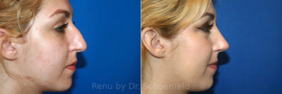 Rhinoplasty Before and After Photos in DC, Patient 12954