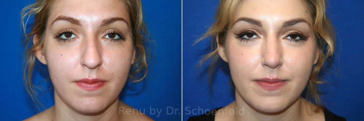 Rhinoplasty Before and After Photos in DC, Patient 12954