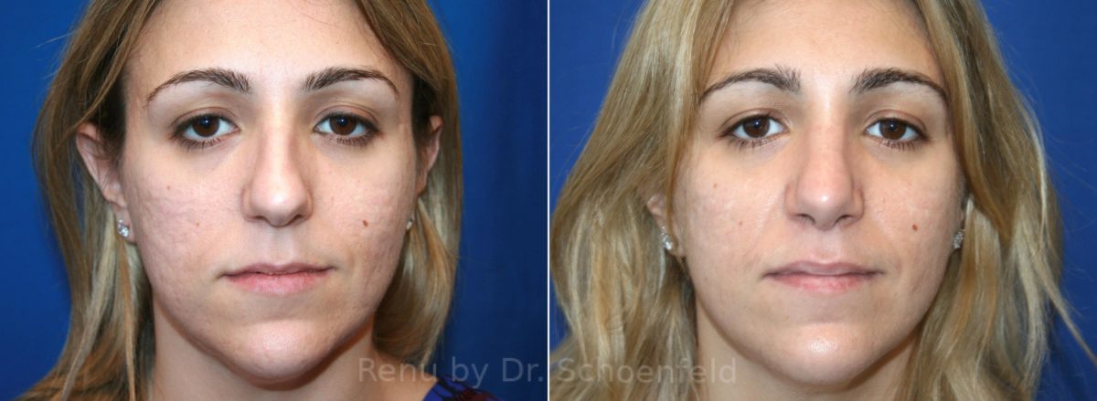 Rhinoplasty Before and After Photos in DC, Patient 12961